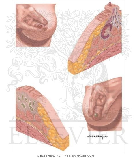 A jóindulatú emlődaganatok - Ductalis ectasia papilloma