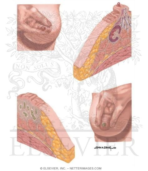 szemölcsök és égési sérülések papilláris endometrium rák