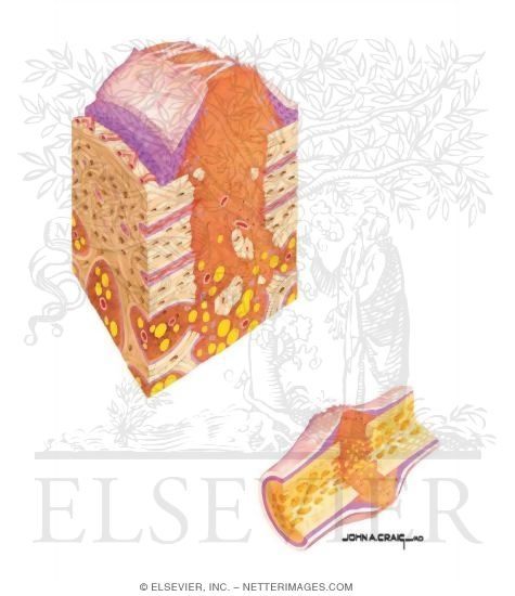 Watermarked preview of unlabeled image: Bone Repair (Early Phase)