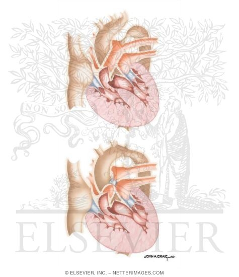 Watermarked preview of unlabeled image: Interrupted Aortic Arch Complex