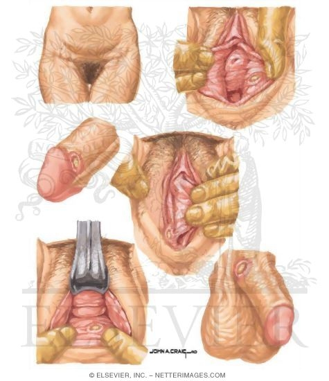 Syphilitic Chancres and Lymphadenopathy
Genital Lesions of Primary Syphilis