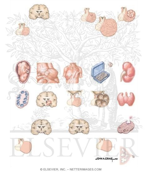 Hyperprolactinemia