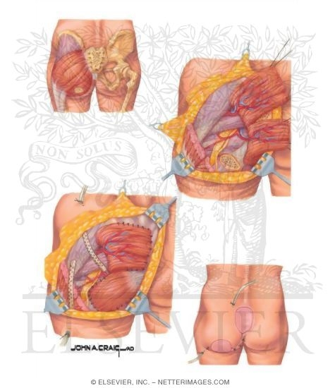 Watermarked preview of unlabeled image: Gluteus Muscle interposition for Ischial and Sarcal Pressure Ulcers
