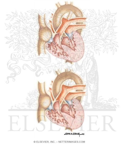 Watermarked preview of unlabeled image: Patent Ductus Arteriosus
