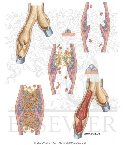 Watermarked preview of unlabeled image: Venous Thrombosis