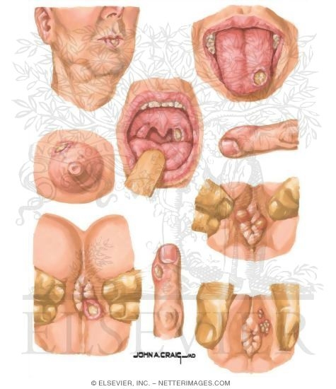 Extragenital Lesions