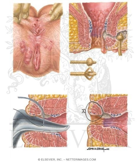 Appearance and Management of Anorectal Crohn Disease
Crohn Disease: Perianal Disease