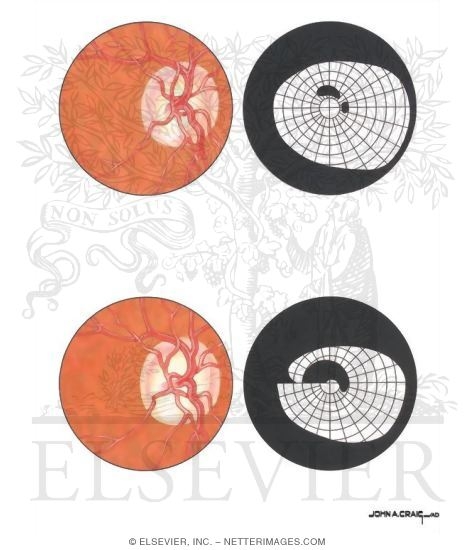 Watermarked preview of unlabeled image: Optic Disc and Visual Field Changes In Glaucoma