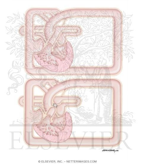 Schematic Showing Affects of an Aortic Stenosis Versus a Normal Heart