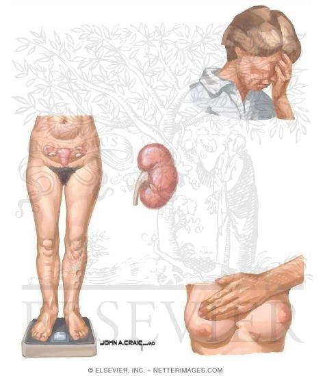 Watermarked preview of unlabeled image: Premenstrual Syndrome