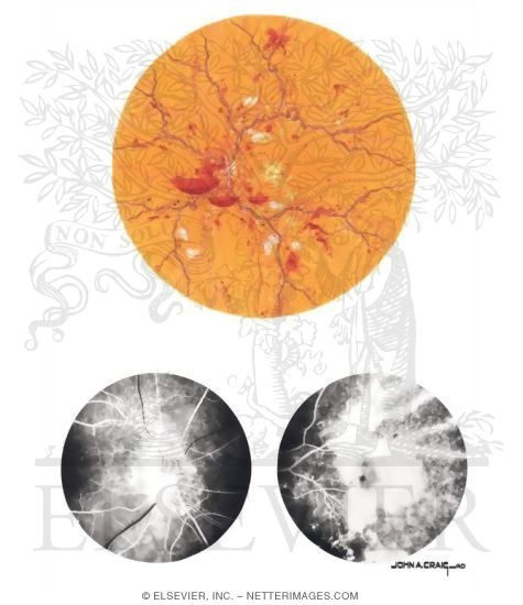 Watermarked preview of unlabeled image: Diabetic Retinopathy