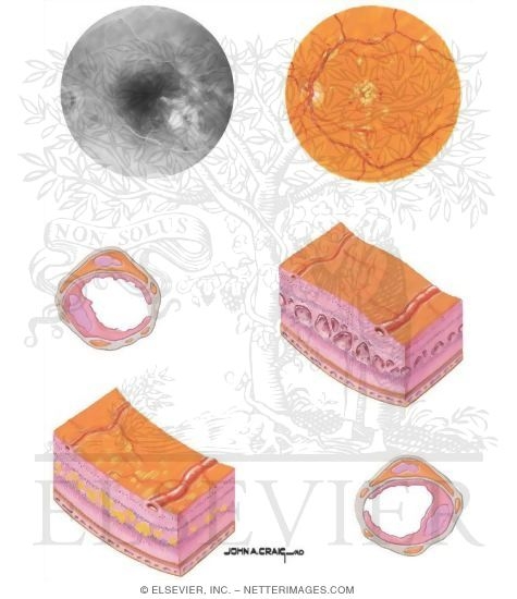 Vascular Permeability