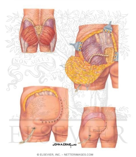 Watermarked preview of unlabeled image: Rotation Flap for Sarcal Pressure Ulcer