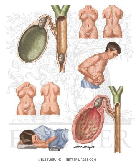 Mechanisms of Biliary Pain