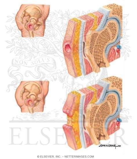 Evolution of Pressure Ulcer