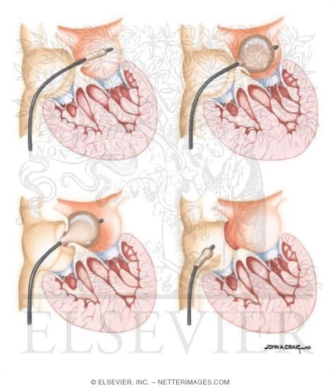 Watermarked preview of unlabeled image: Transposition of Great Arteries