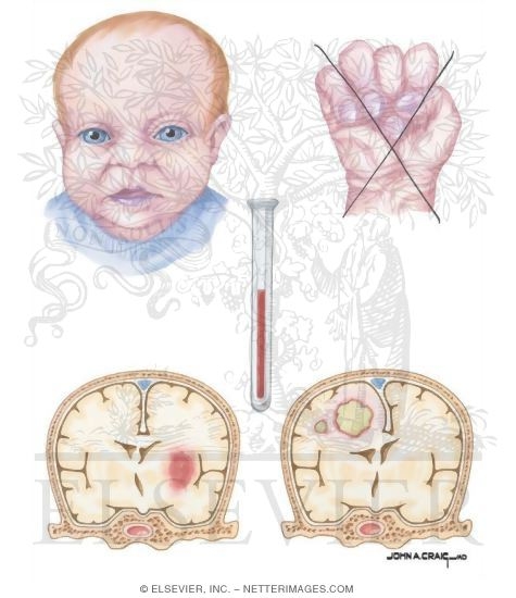 Watermarked preview of unlabeled image: Clinical Characteristics of Too Little Pulmonary Flow