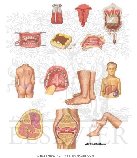 Watermarked preview of unlabeled image: Clinical Presentation of Patients With Bleeding Disorders