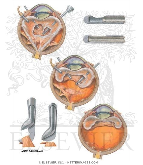 Watermarked preview of unlabeled image: Vitrectomy
