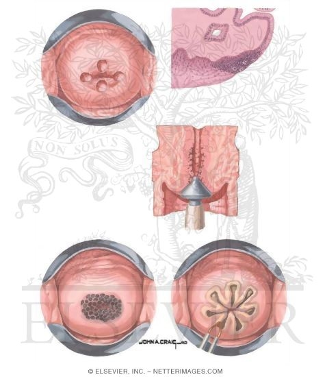 carcinoma in situ cervix cin 3