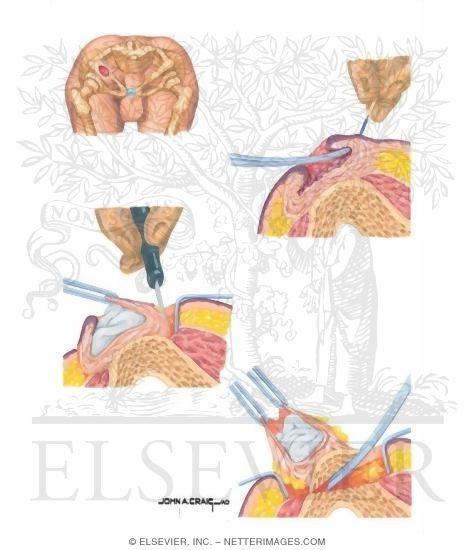 Excision of Ischial Pressure Ulcer