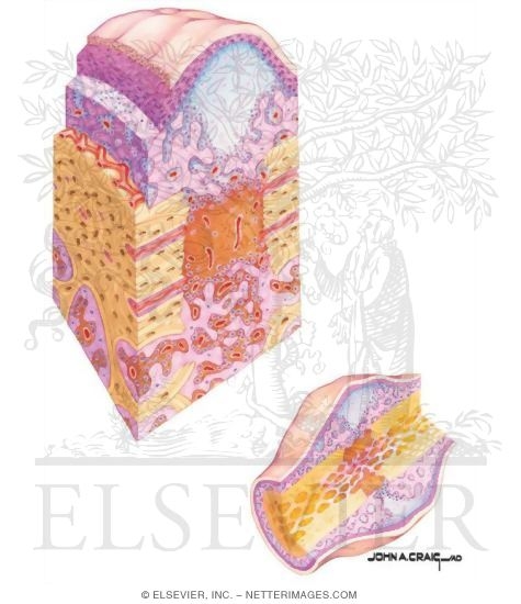 Watermarked preview of unlabeled image: Bone Repair (Intermediate Phase)