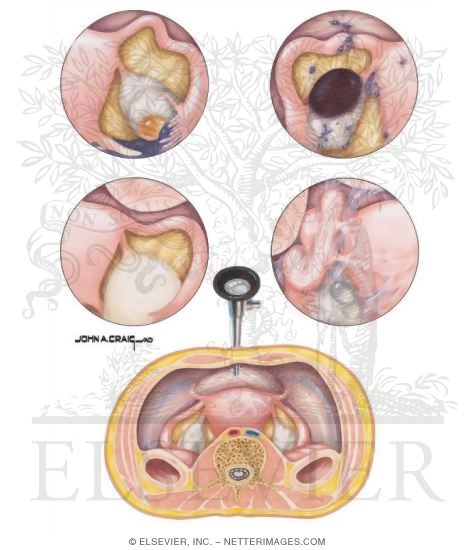 Watermarked preview of unlabeled image: Laparoscopic Views