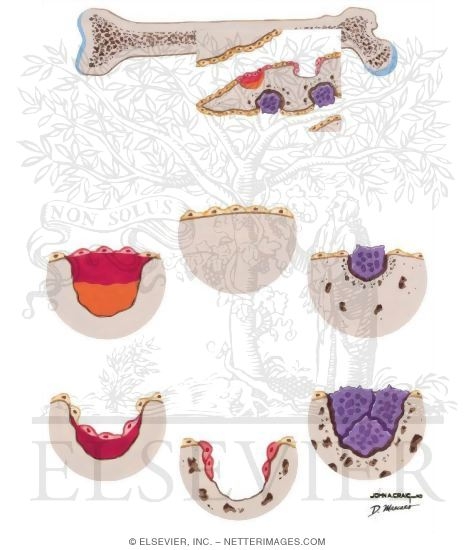 Bone Remodeling Unit