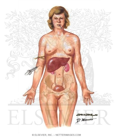 Watermarked preview of unlabeled image: Diagnostic Considerations in Fever of Unknown Origin
