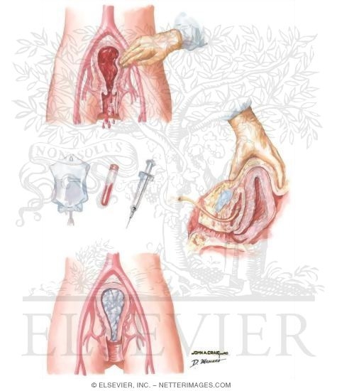Uterine Atony
Uterine Atony (Postpartum)