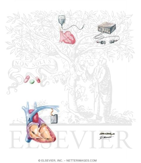 Watermarked preview of unlabeled image: Management of Ventricular Tachycardia
