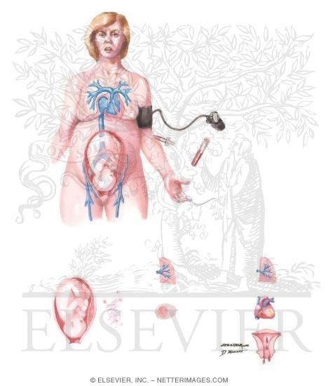 Watermarked preview of unlabeled image: Amniotic Fluid Embolism