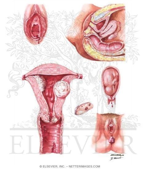 Watermarked preview of unlabeled image: Postcoital Bleeding