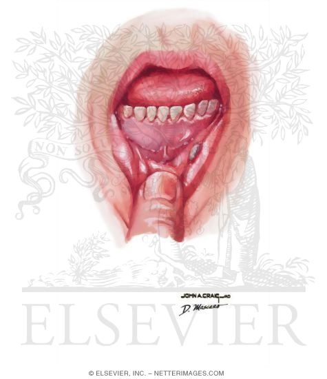 Watermarked preview of unlabeled image: Aphthous Ulcer