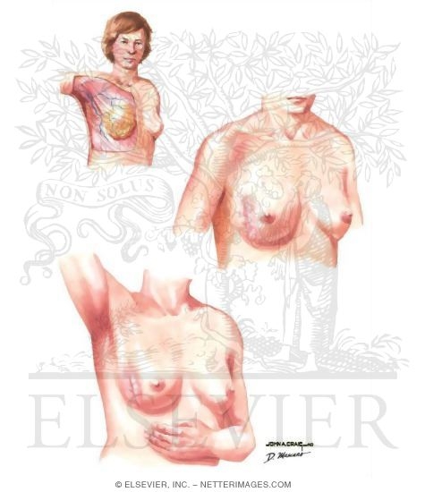 Mondor's Disease
Breast: Mondor's Disease