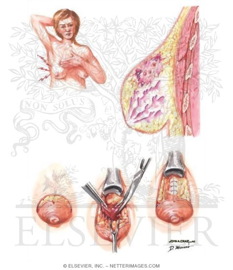 Fat Necrosis of Breast
Breast: Fat Necrosis
Breast: Fat Necrosis/Fat Necrosis of Breast