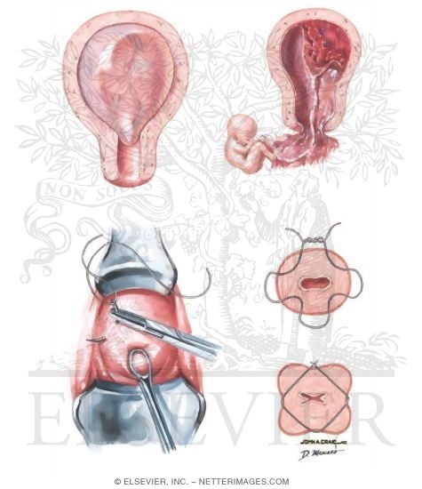 Cervical Incompetence