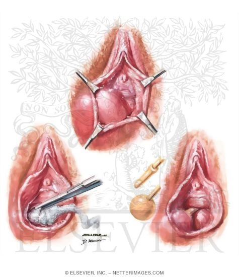 Bartholin Abscess