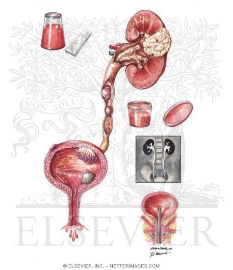 Watermarked preview of unlabeled image: Hematuria