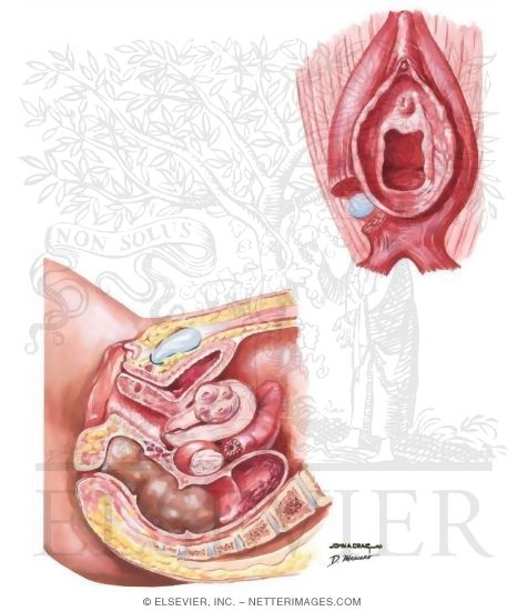 Dyspareunia: Deep Thrust