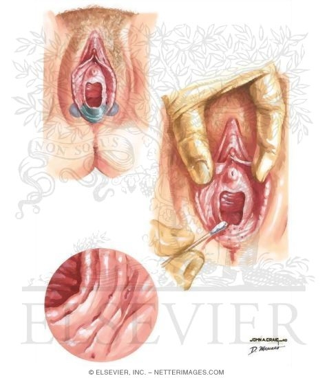 Vulvar Vestibulitis