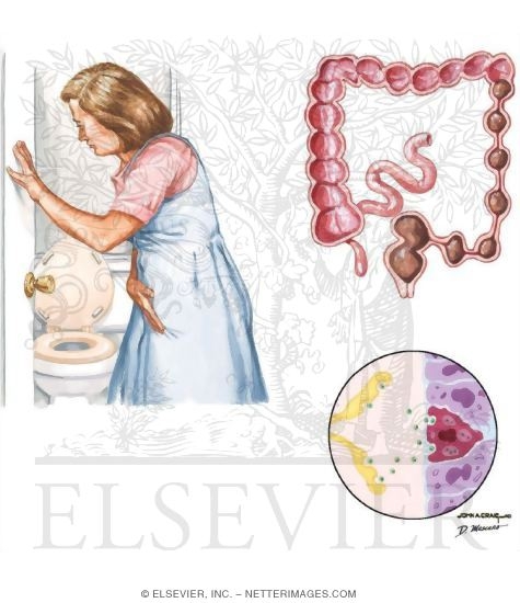 Irritable Bowel Syndrome (IBS)