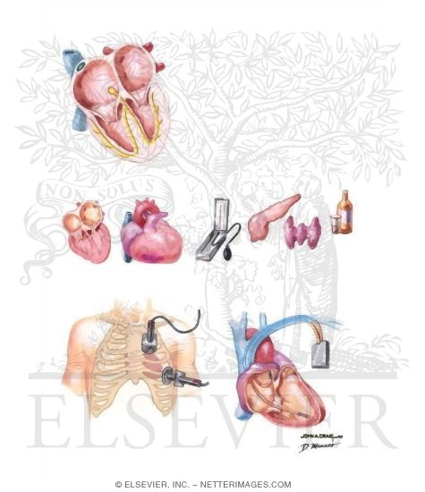 Watermarked preview of unlabeled image: Atrial Fibrillation