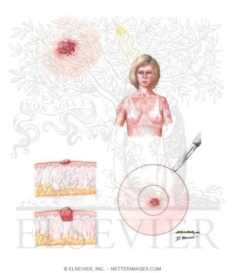 Watermarked preview of unlabeled image: Melanoma