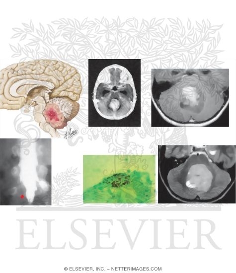 Watermarked preview of unlabeled image: Medulloblastoma