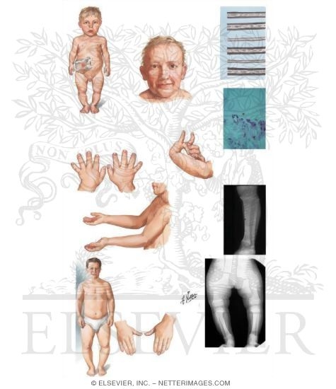 Metaphyseal Chondrodysplasias