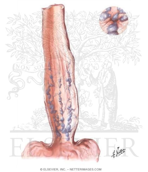 Watermarked preview of unlabeled image: Varicosis