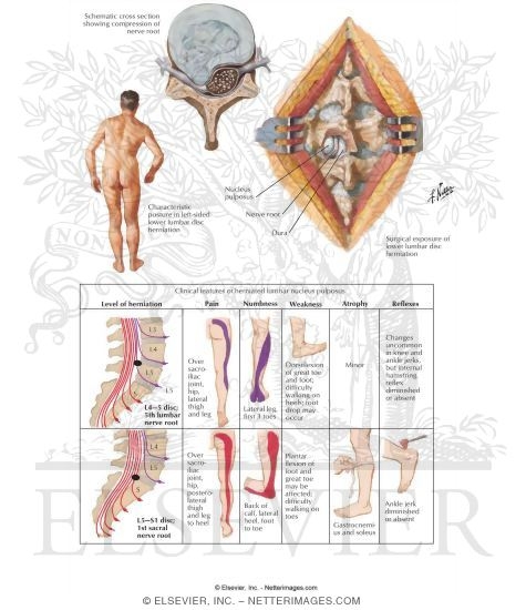 Lumbar Disc Herniation Clinical Manifestations