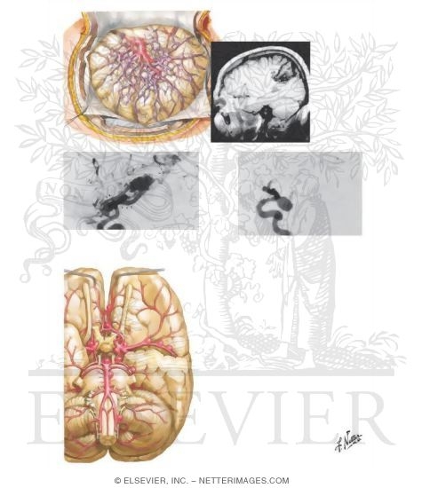 Watermarked preview of unlabeled image: Vascular Malformations and Aneurysms