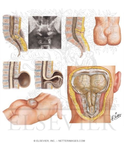 Watermarked preview of unlabeled image: Spinal Dysraphism